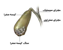 نشانه‌های مشکلات کیسه صفرا