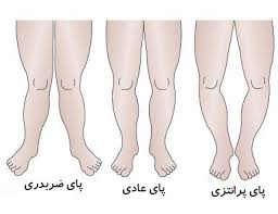 علت پای پرانتزی از کودکی تا سالمندی