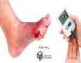 درمان تخصصی زخم پای دیابتی | کلینیک زخم بهبودان